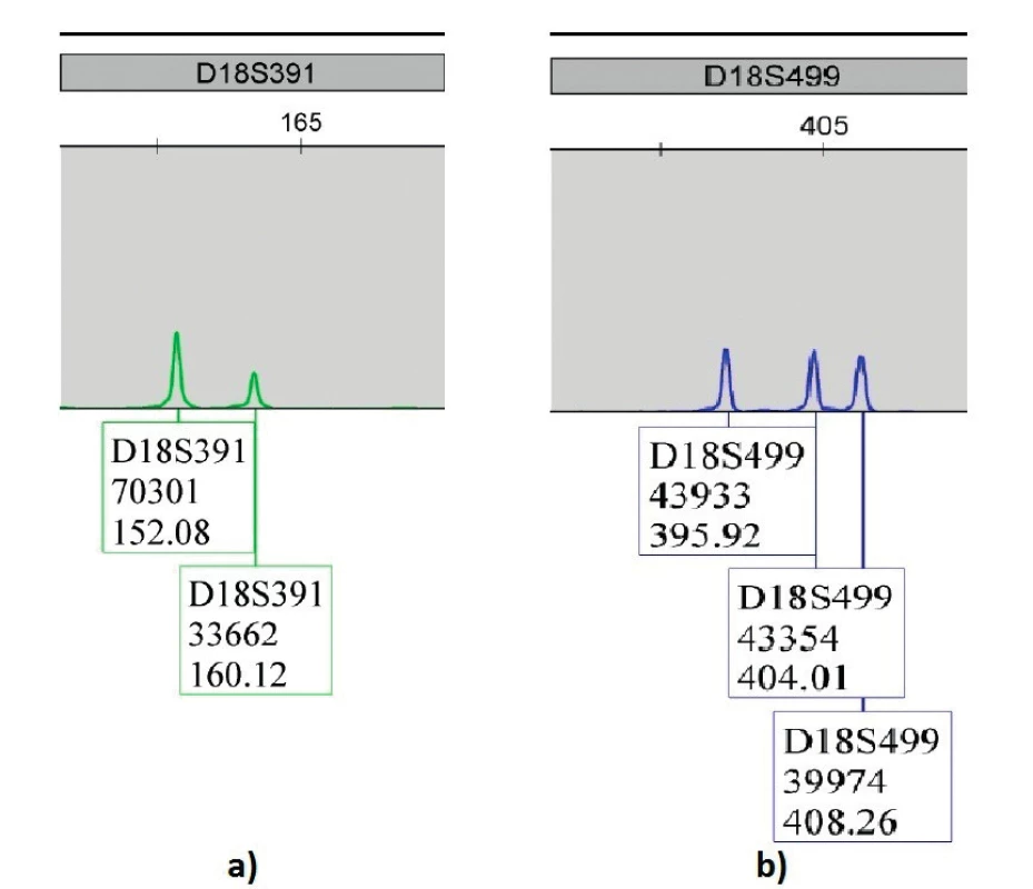 Výsledky QF-PCR plodovej vody u plodu postihnutého trizómiou 18 – Edwardsov syndróm; a) marker D18S39133662 dialelická trizomická vzorka 2:1; b) marker D18S49943354 trialelická trizomická vzorka 1:1:1