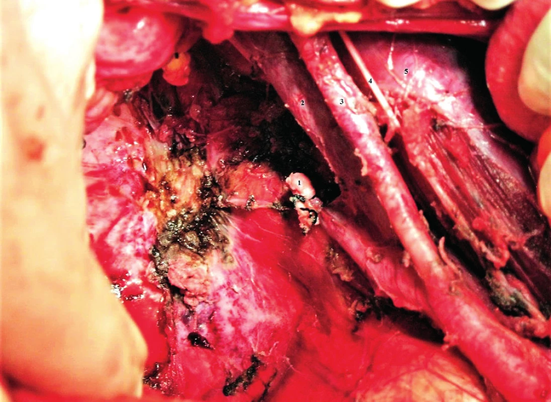 Oblast resekce arteria iliaca interna vpravo