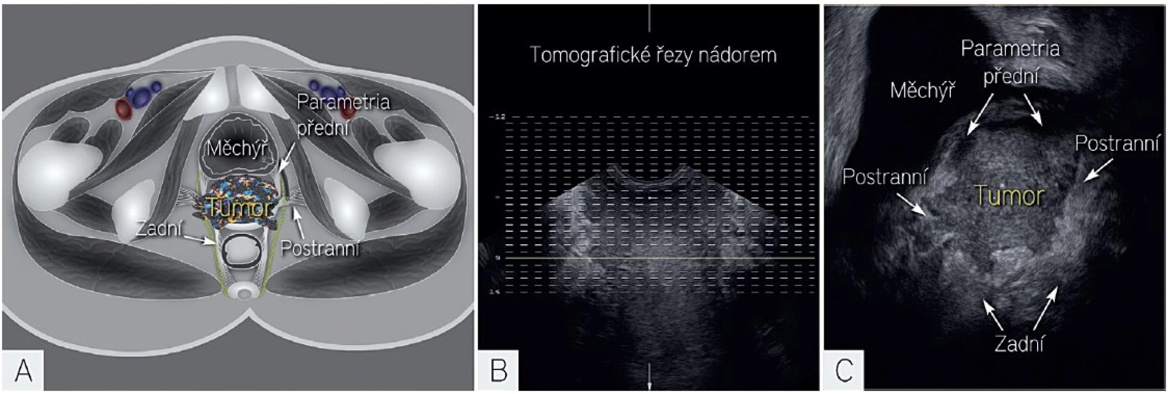 Tomografické řezy v 3D ultrazvuku