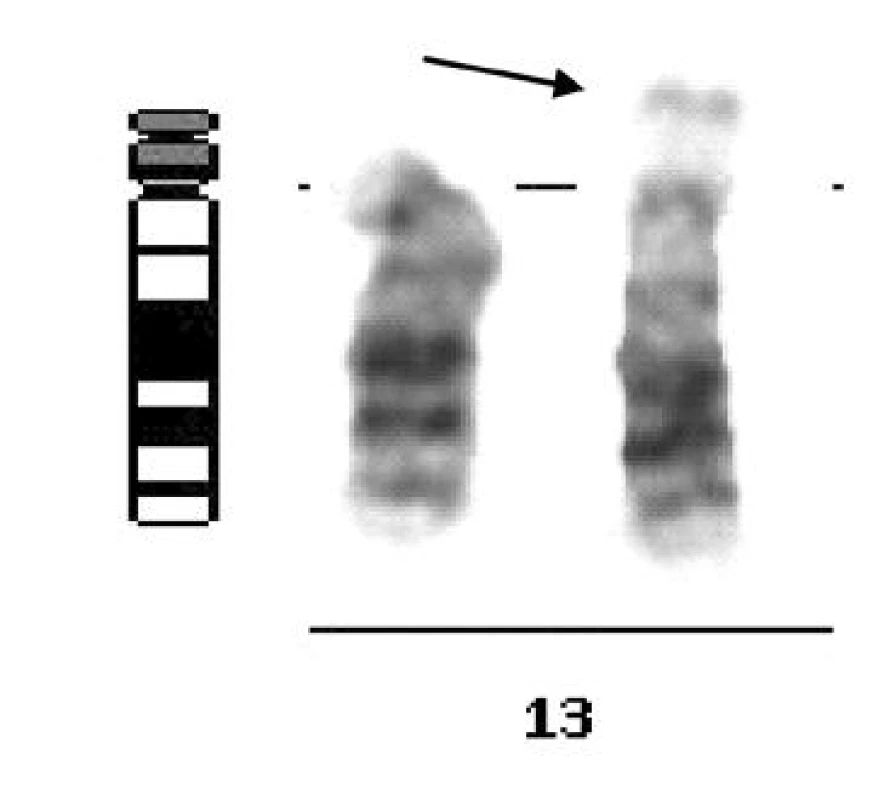 Délková varianta satelitů 13. chromozomu, 13ps+, jako zástupce skupiny variant akrocentrických chromozomů