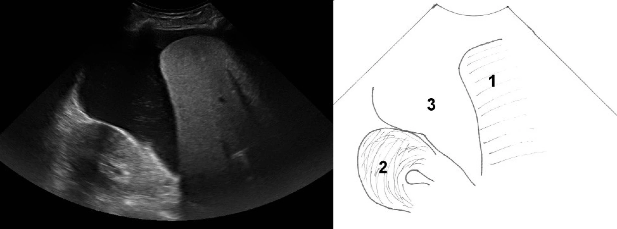 Zobrazení pravého hypochondria. 1 – pravý lalok jater, 2 – kůra pravé ledviny, 3 – anechogenní volná tekutina (v tomto případě ascites) separující prostor mezi játry a ledvinou