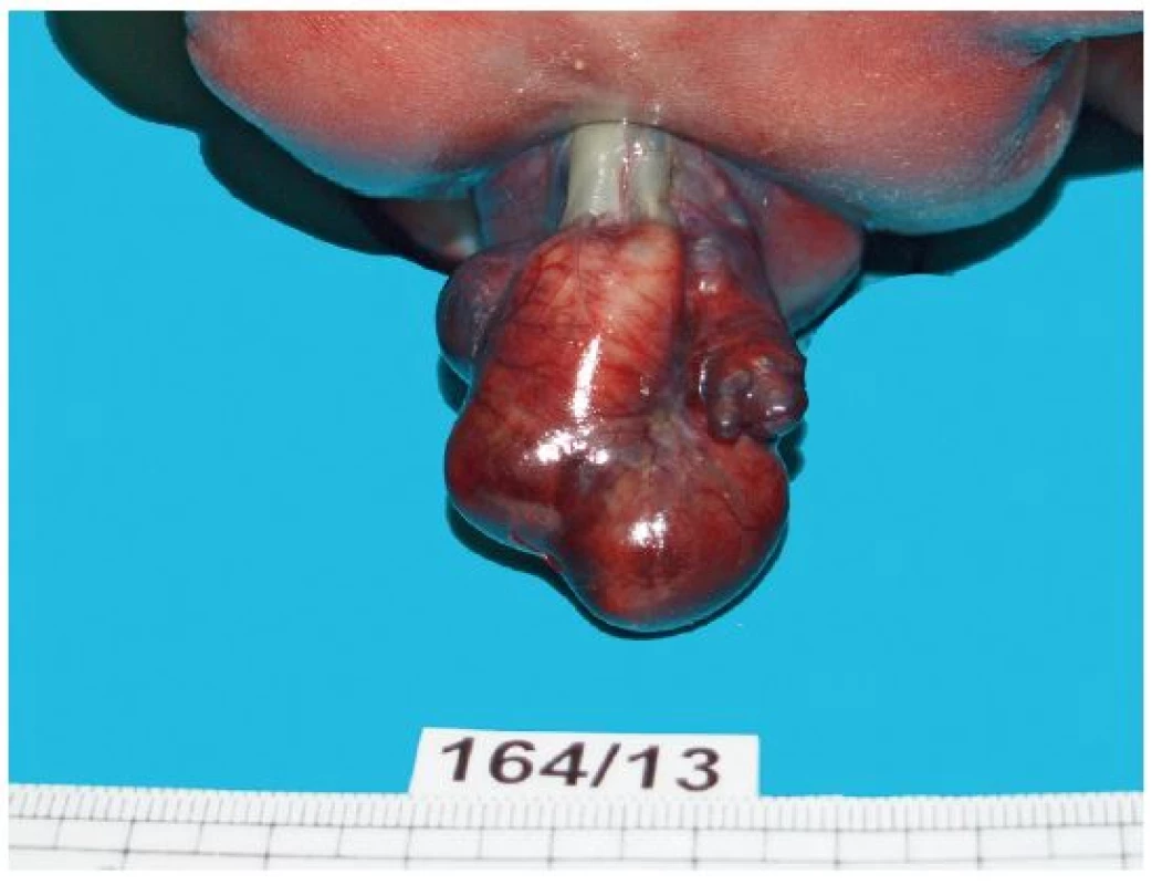 Patologicko-anatomický nález na plodu – stopka velkých cév s EC