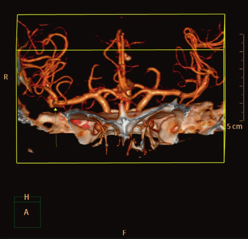 Angio CT vyšetření mozku pacientky