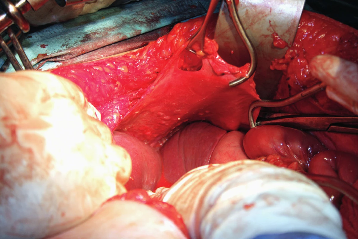 Stripping peritonea bránice