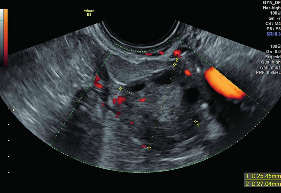 Ovariální ASN – tumor ze Sertoliho-Leydigových buněk uložený intraovariálně v průměru 18×14×10 mm (zvýrazněn červeným ohraničením), při celkové normální velkosti ovaria