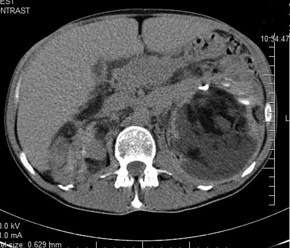 CT zobrazenie nádoru v retroperitoneu