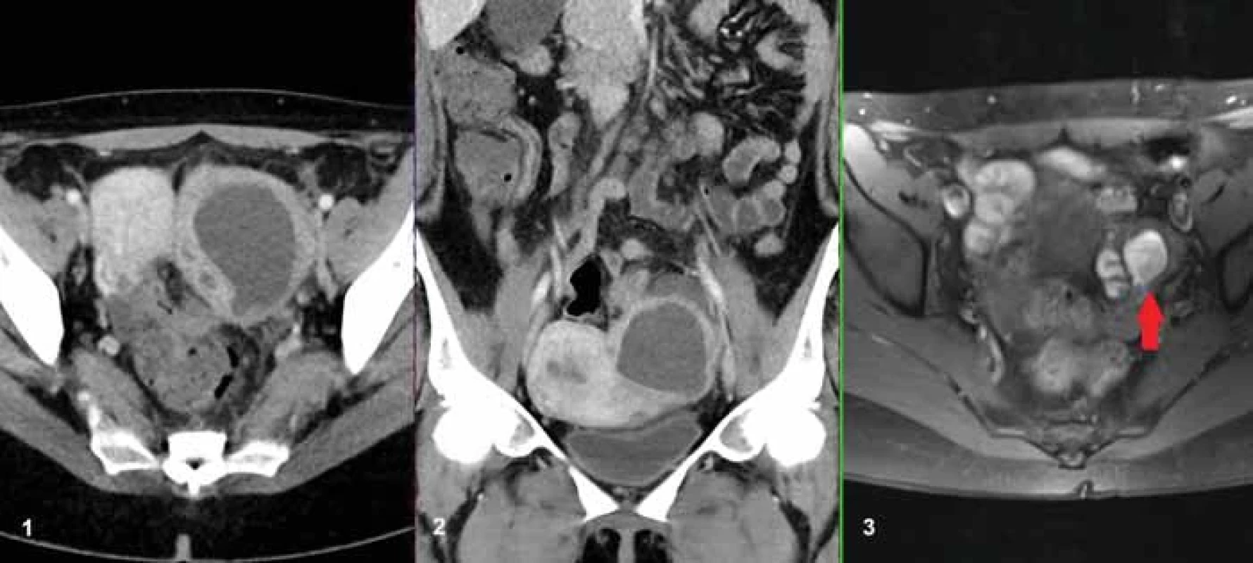 36letá pacientka vyšetřená na konci šestinedělí pro trvající bolesti břicha a známky zánětu v laboratorním obraze. Na obr. A a B je patrný TOA v axiální a koronární rovině na levém ovariu. Na obr. C je v MR obraze v T1 vážení s potlačením signálu tuku provedeném 1 rok před porodem patrna endometroidní cysta na levém ovariu (červená šipka). 