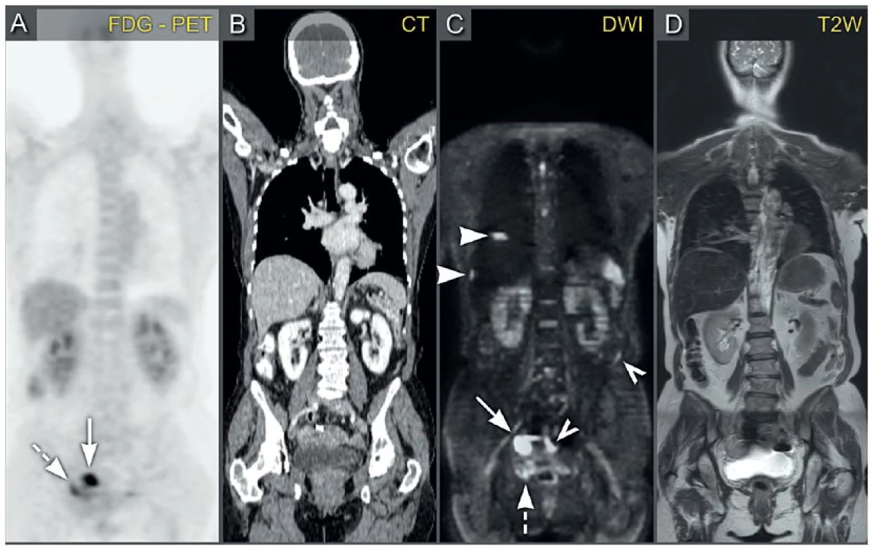 Pokročilý ovariální karcinom s nádorovým rozsevem po břišním peritoneu