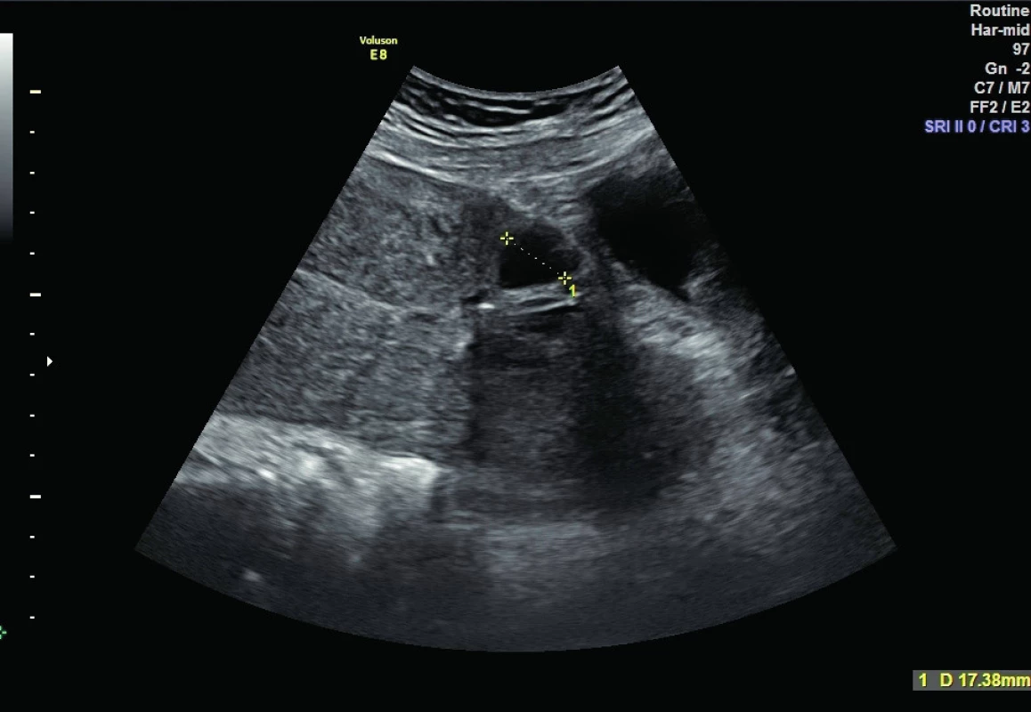 Ultrazvukový nález 2. den po porodu