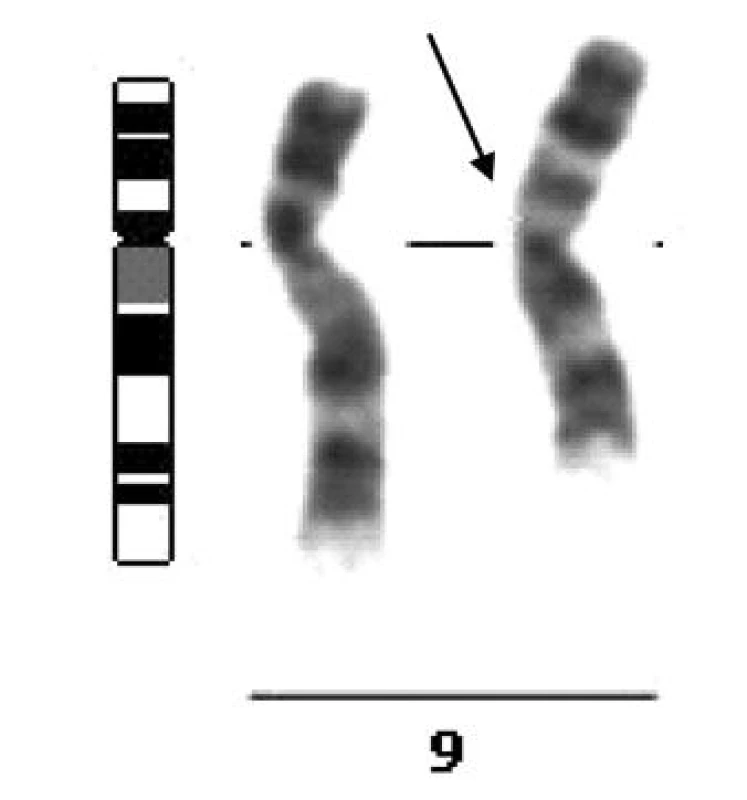 Inverze na 9. chromozomu, inv(9)(p12q13), jako zástupce heterochromatinových variant karyotypu