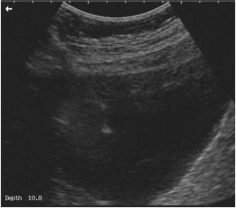 Punkce lymfocysty. Jehla je vedena z levé části obrázku (zprava z pacientčina pohledu), po celou dobu punkce je ultrazvukem vizualizována pozice jehly a jejího hrotu.