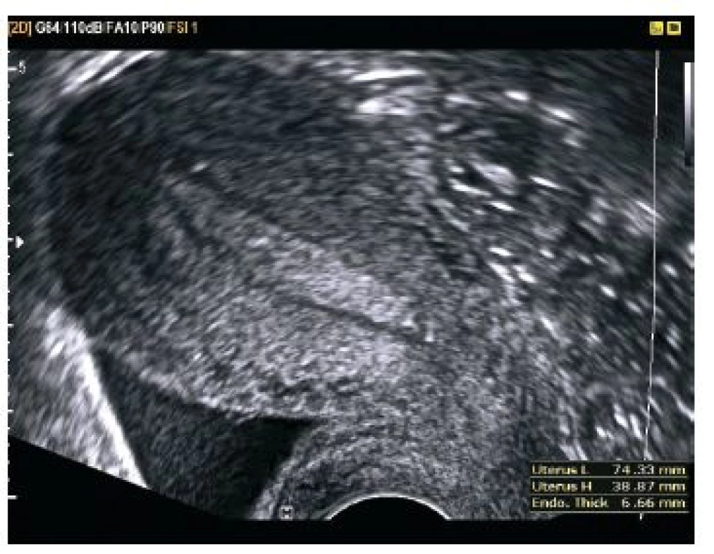 Děloha v RVF, vel. 74,33×38×40 mm, endometrium 6,6 mm, bez známek intrauterinní gravidity. V CD malé množství volné tekutiny, patrné hyperechogenní odrazy – suspektní hemoperitoneum