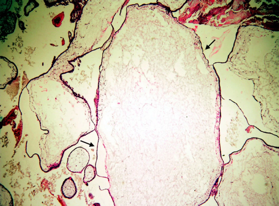 Mola hydatidosa completa: těžký edém klků (zvětšení 50 x!) mezi šipkami, atrofie trofoblastu centrálních částí moly, cysterny
