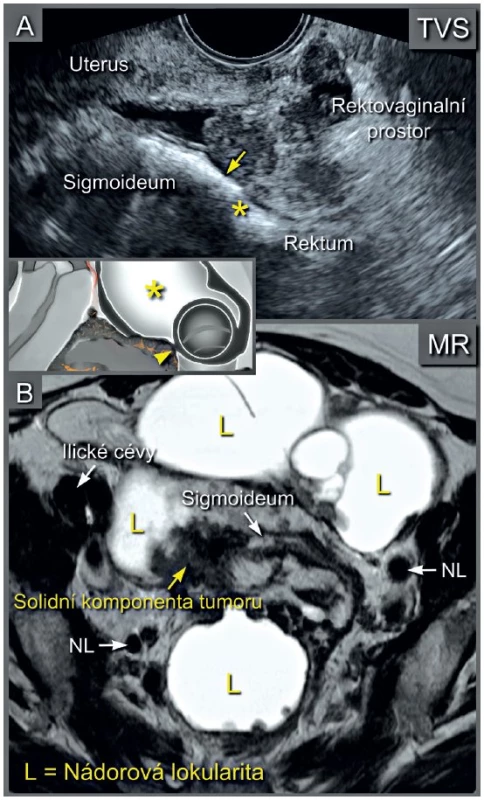 Multilokulární-solidní ovariální karcinom infiltrující svalovou vrstvu (muscularis propria) sigmoidea