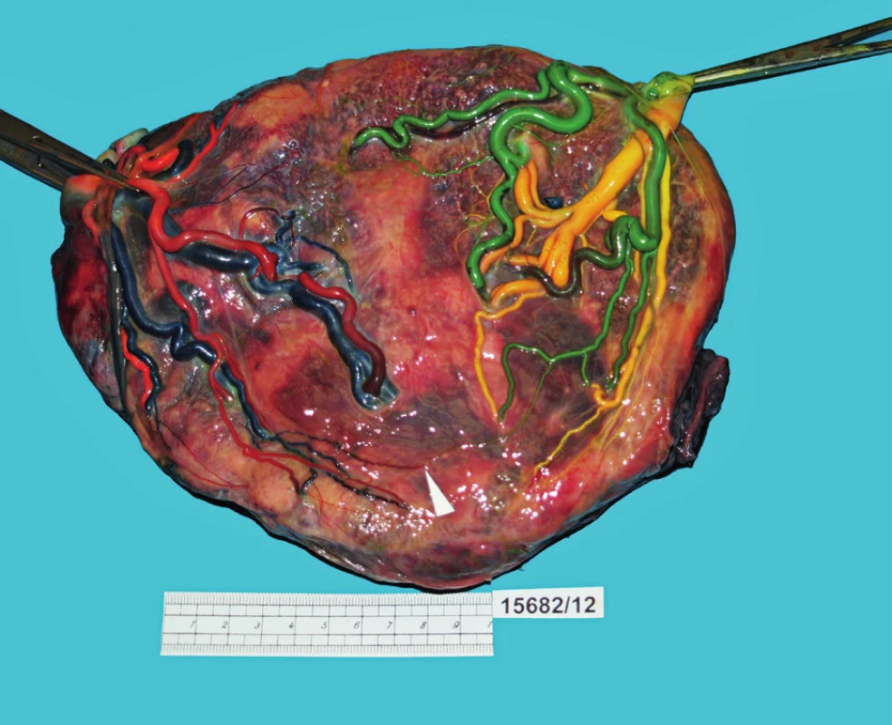 Barvení cévního řečiště placenty u případu spontánního TAPS (případ A). Charakteristický obraz placentárního cévního řečiště s přítomností drobné A–V anastomózy bez přítomnosti jiných (kompenzatorních) cévních anastomóz.
