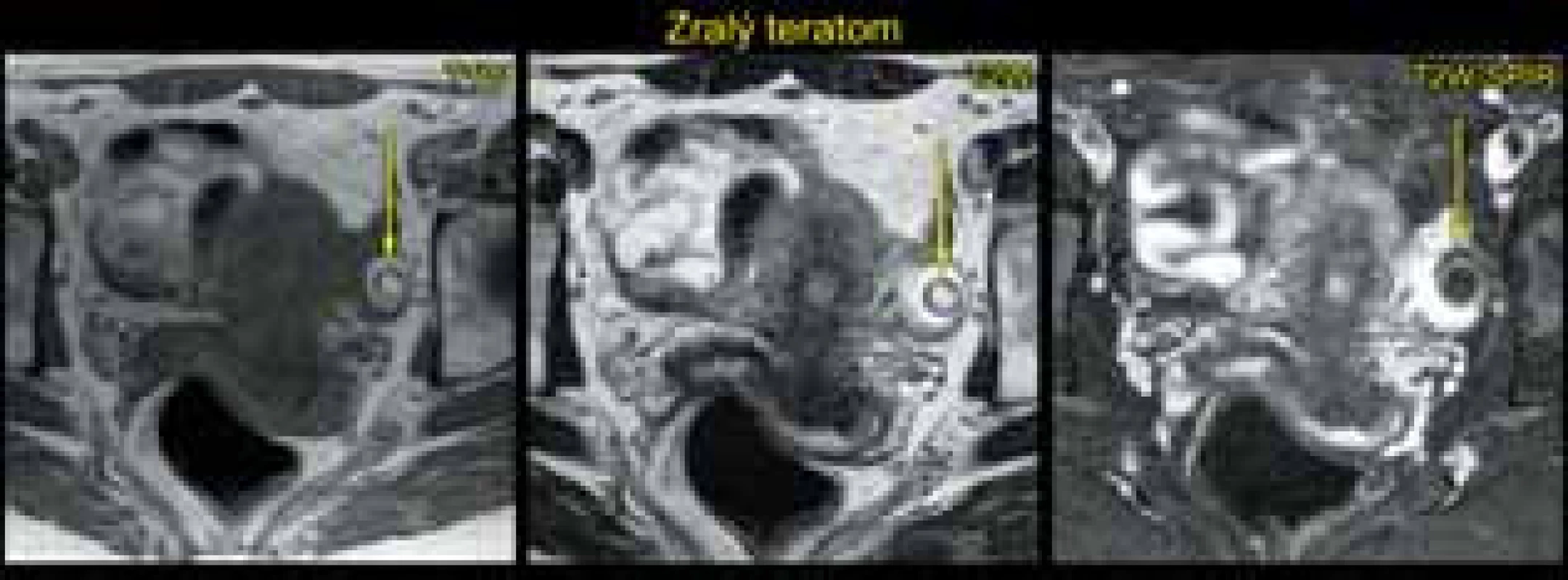 Endometroidní cysty na obou ovariích při vyšetření magnetickou rezonancí