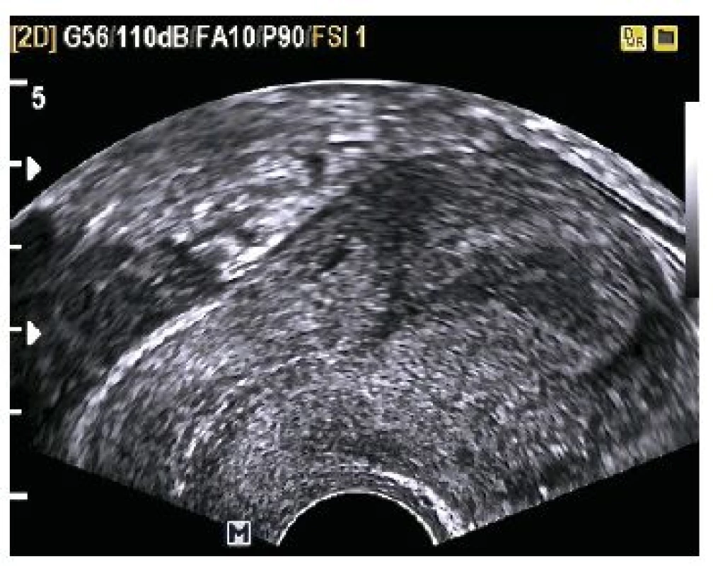 Endometrium heterogenní – 11,93 mm, bez známek intrauterinní gravidity