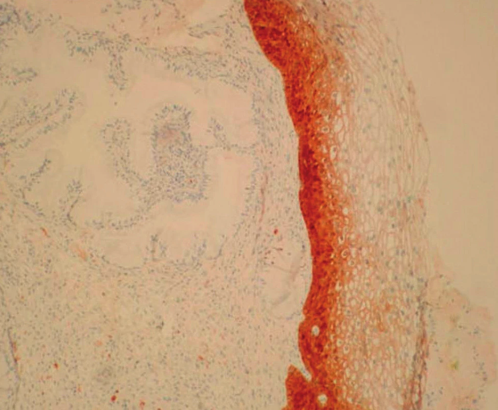 PCIN1 – difuzní pozitivita spodní 1/3 cervikálního epitelu