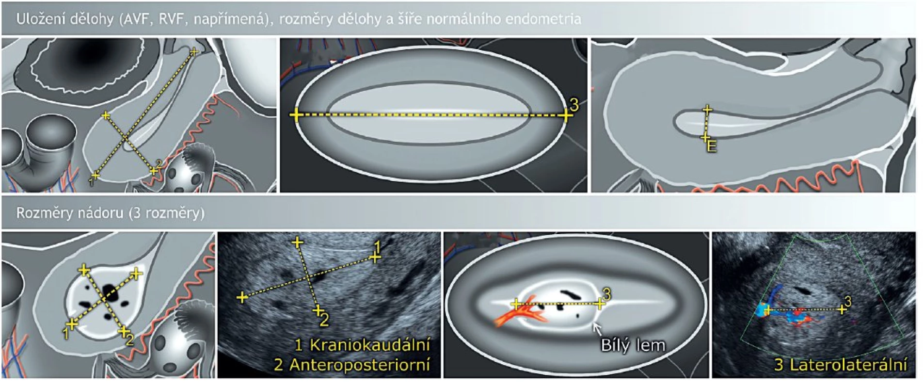Zobrazení dělohy transvaginálním ultrazvukem v sagitální a transverzální rovině