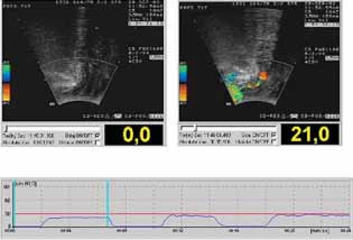 UZ vyšetření s měřením intrarektálního tlaku, tzn. intraabdominálního tlaku; obrázek vlevo: uložení uretry na začátku měření; obrázek vpravo: uložení uretry při úniku moči při intraabdominálním tlaku 21 cm H&lt;sub&gt;2&lt;/sub&gt;O. Dolní obrázek: tlaková křivka s označením místa křivky, kterému odpovídají UZ obrazy – modré kolmice)
