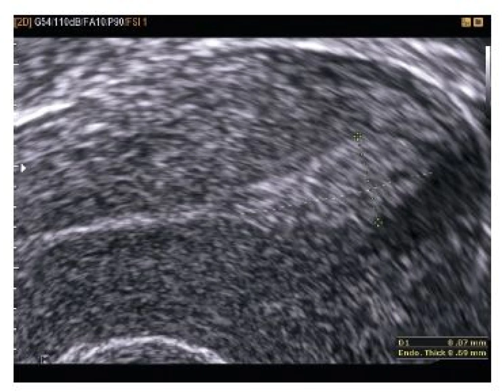 EE – 8,69 mm, v dutině děložní uvnitř deciduálně změněného endometria centricky umístěná anechogenní dutinka protáhlého tvaru bez charakteristického hyperechogenního lemu – suspektní pseudogestační váček