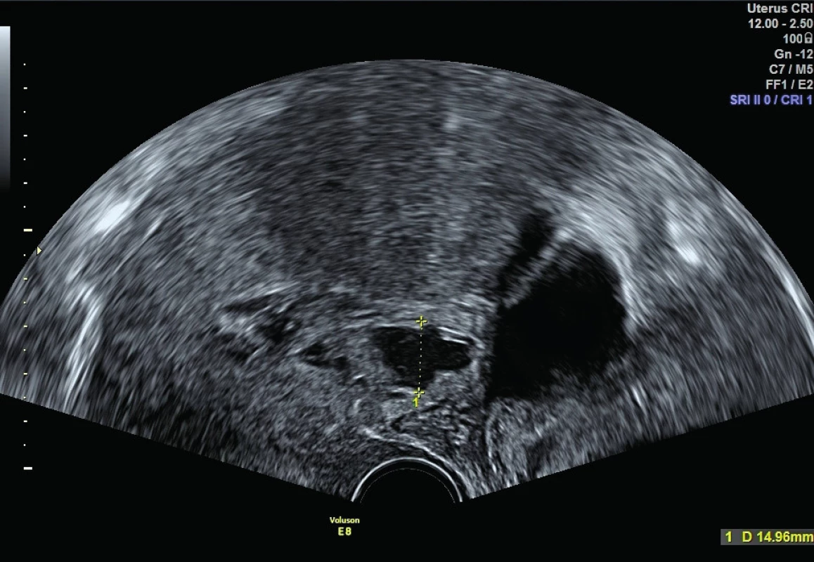 Ultrazvukový nález 2. den po porodu