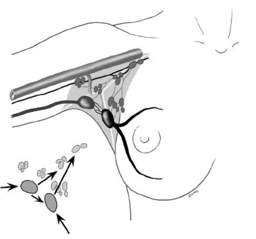 Schematické znázornění lymfatické drenáže horní končetiny a prsu. Šipky ukazují směr toku lymfy
