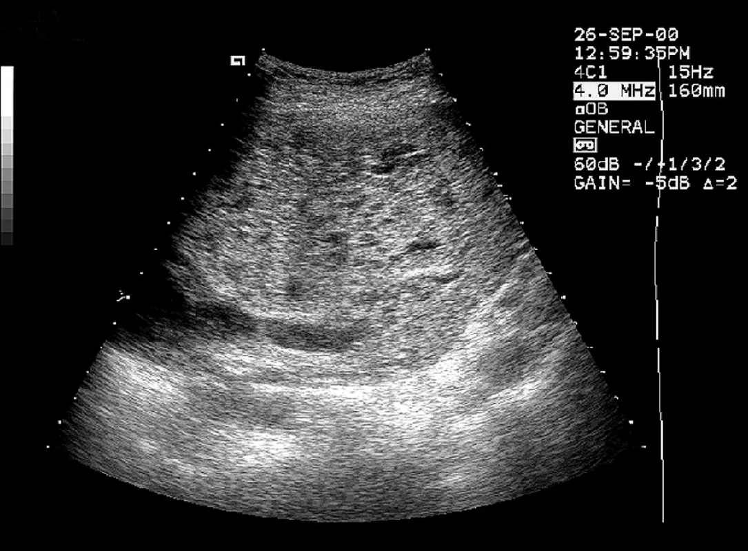 Mola completa – II. trimestr těhotenství, nehomogenní masa s různě velkými cystickými strukturami obraz tzv. snowstorm, plod chybí