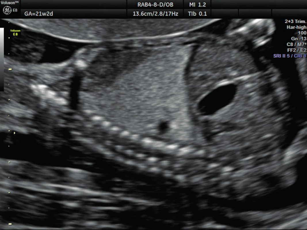 Ultrazvukové vyšetření ve 21. týdnu těhotenství – bronchopulmonální sekvestrace
Levá kaudální část hemitoraxu je vyplněna trojúhelníkovým hyperchogenním útvarem o velikosti 3–4 cm (plicní sekvestr)