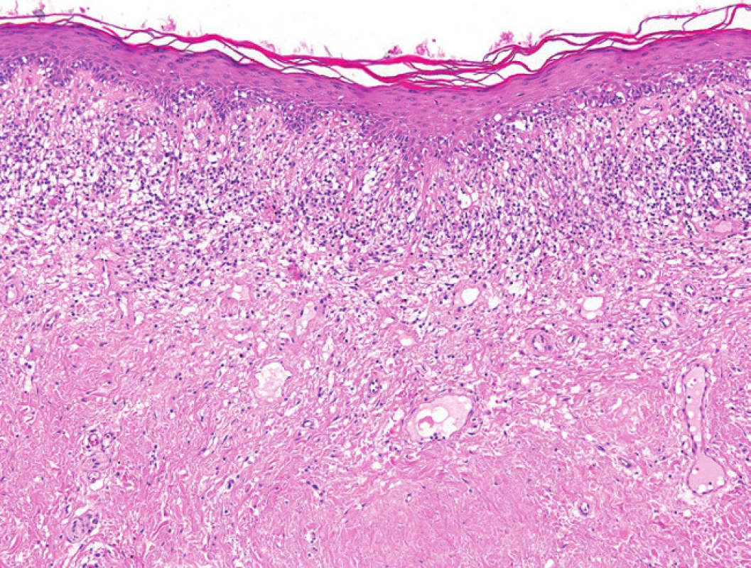 Inflamatorní stadium lichen sclerosus