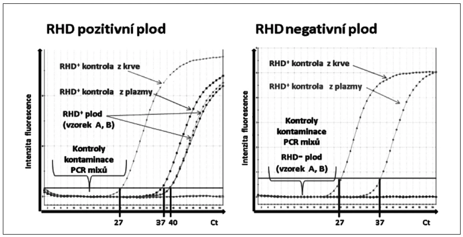Ukázka rozlišení &lt;i&gt;RHD&lt;/i&gt; pozitivního a &lt;i&gt;RHD&lt;/i&gt; negativního plodu pomocí real-time polymerázové řetězové reakce (PCR).
Amplifikační křivky znázorňují fluorescenční intenzitu exonu 7 genu &lt;i&gt;RHD&lt;/i&gt; v závislosti na počtu PCR cyklů (Ct). &lt;i&gt;RHD&lt;/i&gt;+ kontrola z krve: &lt;i&gt;RHD&lt;/i&gt;+ DNA izolovaná z leukocytů periferní krve. &lt;i&gt;RHD&lt;/i&gt;+ kontrola z plazmy: &lt;i&gt;RHD&lt;/i&gt;+ DNA izolovaná z krevní plazmy těhotné &lt;i&gt;RHD&lt;/i&gt;- ženy. &lt;i&gt;RHD&lt;/i&gt;+ plod: &lt;i&gt;RHD&lt;/i&gt;+ vzorky („A“a „B“) DNA izolované z krevní plazmy těhotné &lt;i&gt;RHD&lt;/i&gt;- ženy. &lt;i&gt;RHD&lt;/i&gt;- plod: &lt;i&gt;RHD&lt;/i&gt;- vzorek DNA izolované z krevní plazmy těhotné &lt;i&gt;RHD&lt;/i&gt; negativní ženy. Kontroly kontaminace PCR &lt;i&gt;RHD&lt;/i&gt;: PCR mix pro DNA izolovanou z leukocytů s PCR vodou a PCR mix pro DNA izolovanou z plazmy s PCR vodou.