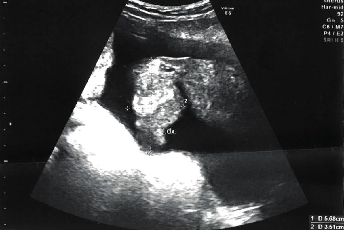 Ultrazvukový snímek malé pánve: výrazně dilatován pravý vejcovod, ascites