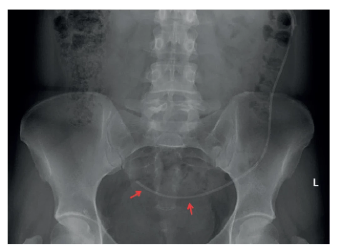 Na rentgenovém snímku pacientka se zavedeným ventrikuloperitoneálním shuntem (konec peritoneálního katétru v malé pánvi označen červenými šipkami)