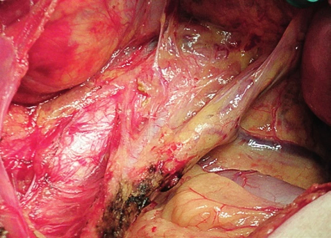 Systematická transperitoneální paraaortální lymfadenektomie – první krok; peritoneum otevřeno v průběhu radixu mezenteria, mobilizováno a odsunuto cékum, colon ascendens a duodenum a získán přehledný přístup do retroperitonea