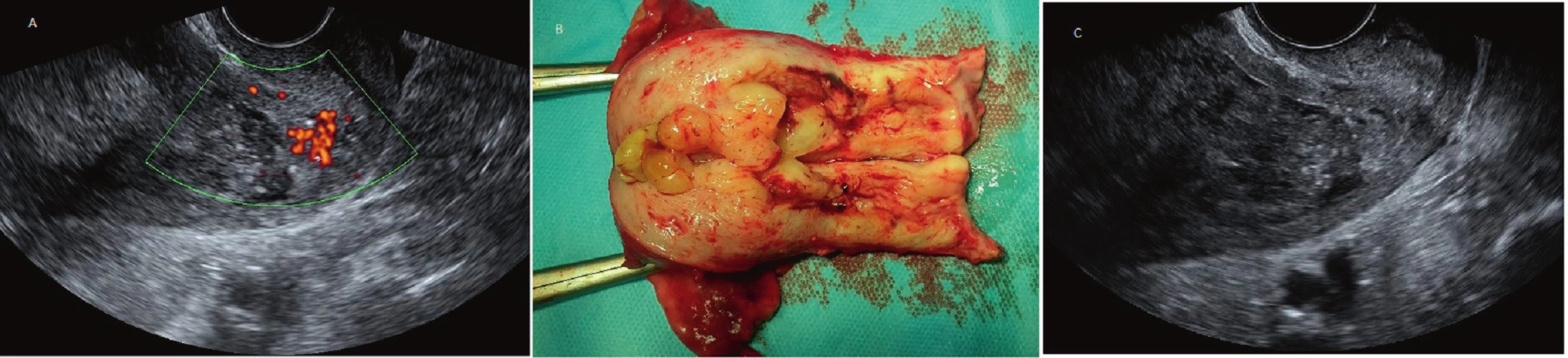 Ultrazvukové zobrazení karcinomu endometria stadia pT1a.