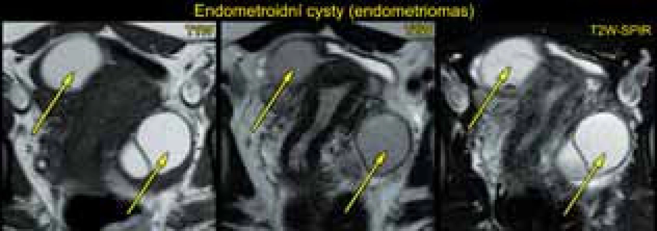 Zralý teratom na levém ovariu při vyšetření magnetickou rezonancí