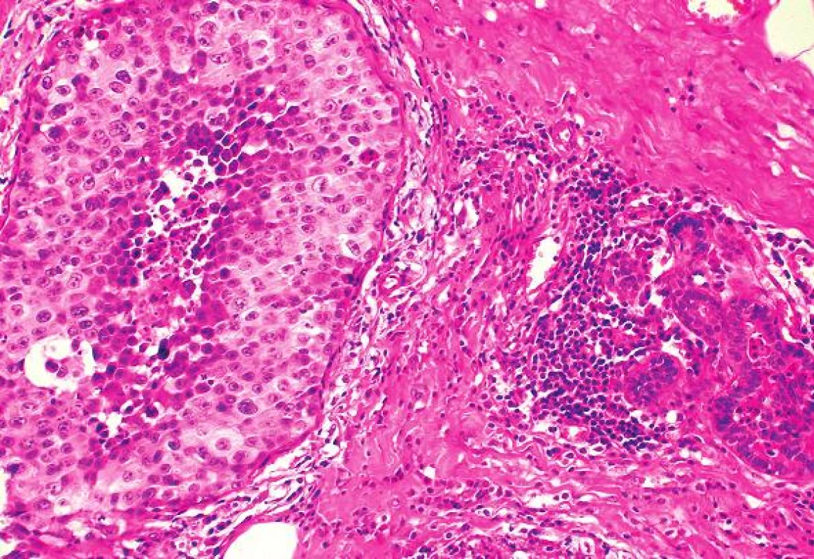 Metastáza melanomu napodobující duktální „komedo“ in situ karcinom. Vpravo původní sekreční struktury mléčné žlázy