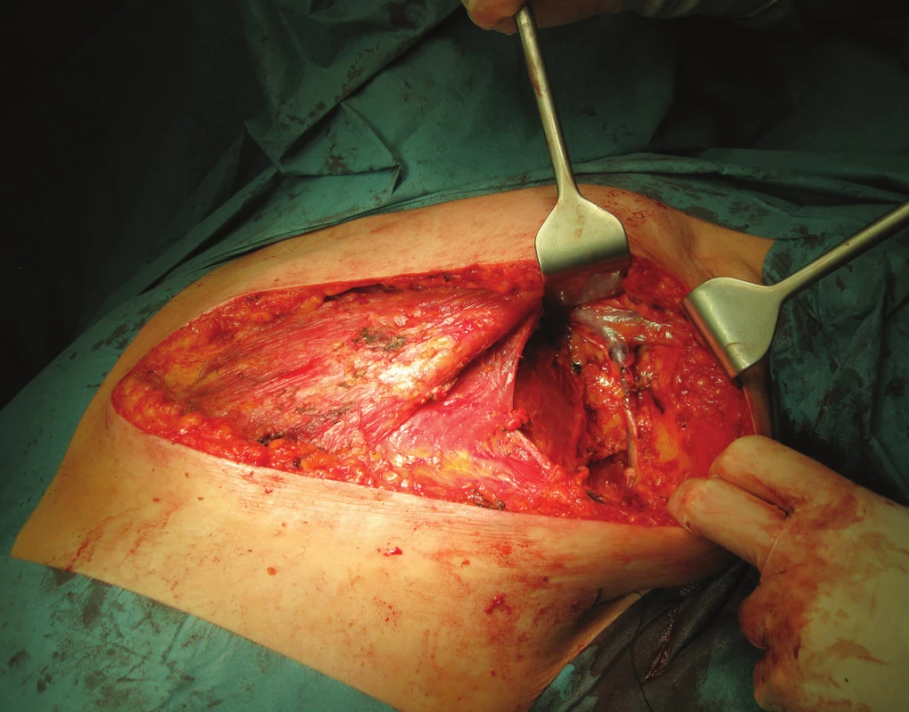 Operační pole po radikální mastektomii