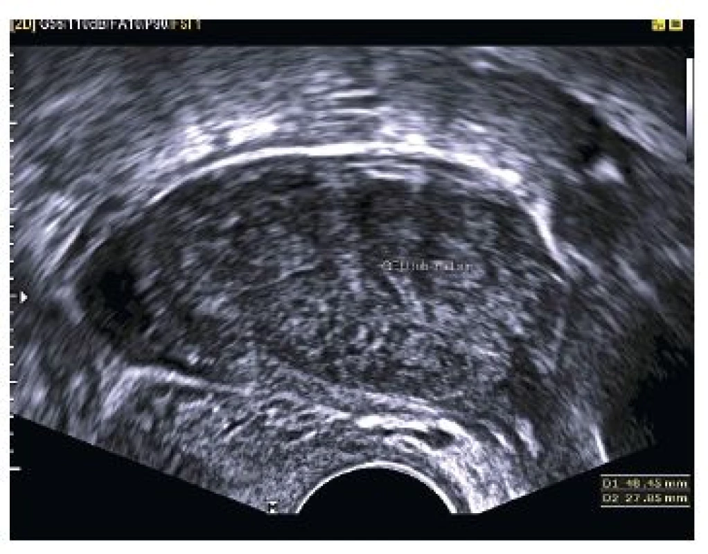 Podlouhlý útvar s heterogenním obsahem (v.s. koagula) rozměrů 48,45×27,85 mm odstupující od pravého děložního rohu (při použití barevného dopplerovského mapování) 
– graviditas extrauterina tubaria