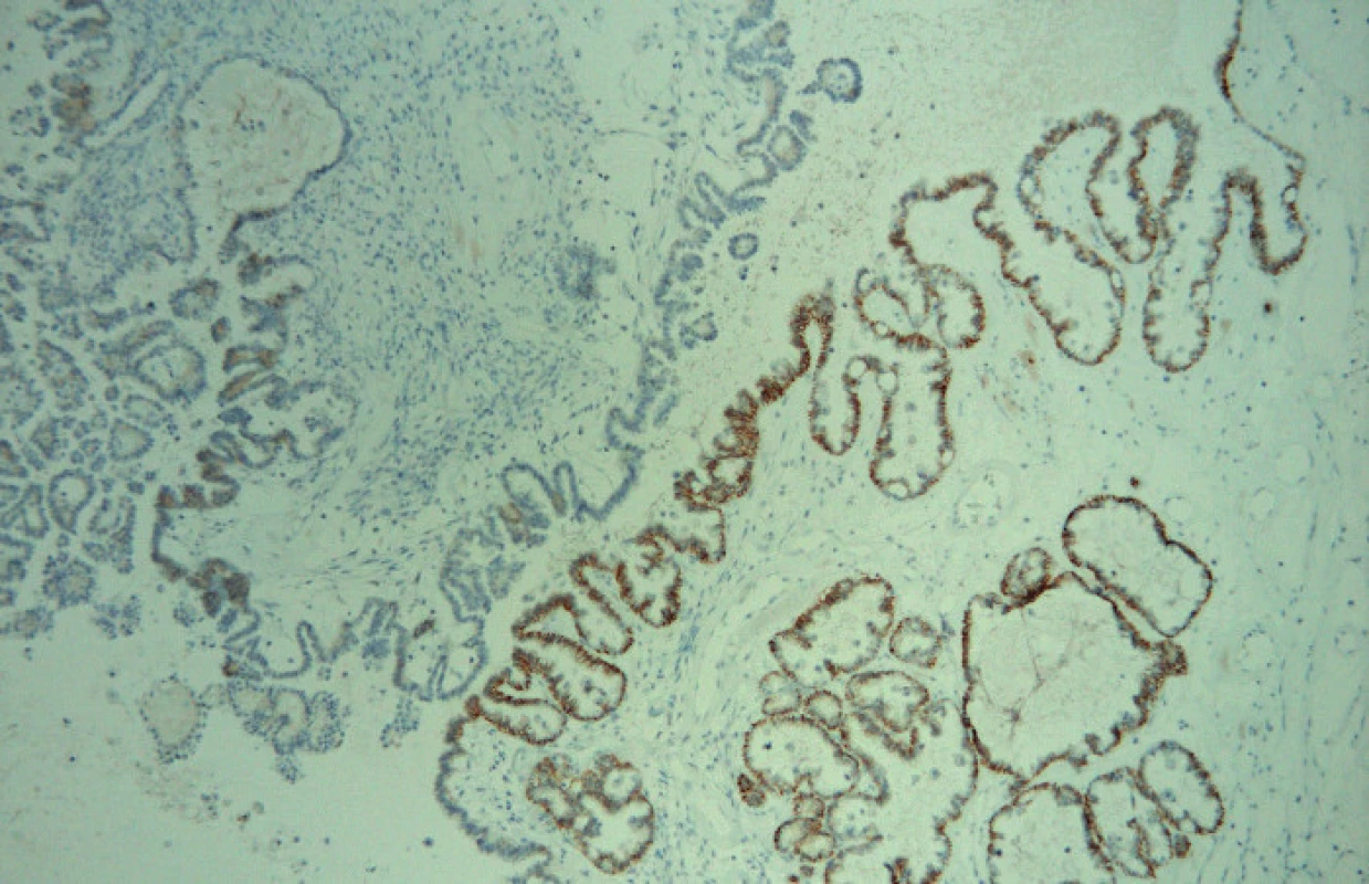 Fokální cytoplazmatická pozitivita MRP3 (zvětšeno 100×)
