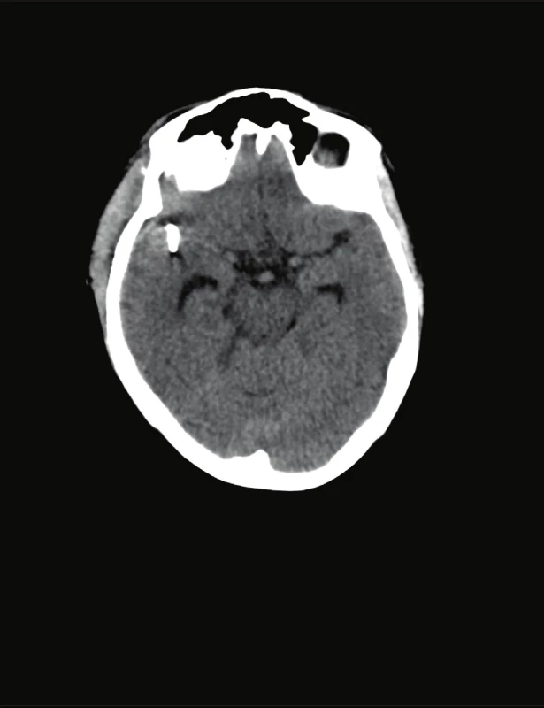 Kontrolní nativní CT mozku s viditelným klipem a vymizením denzity SAK