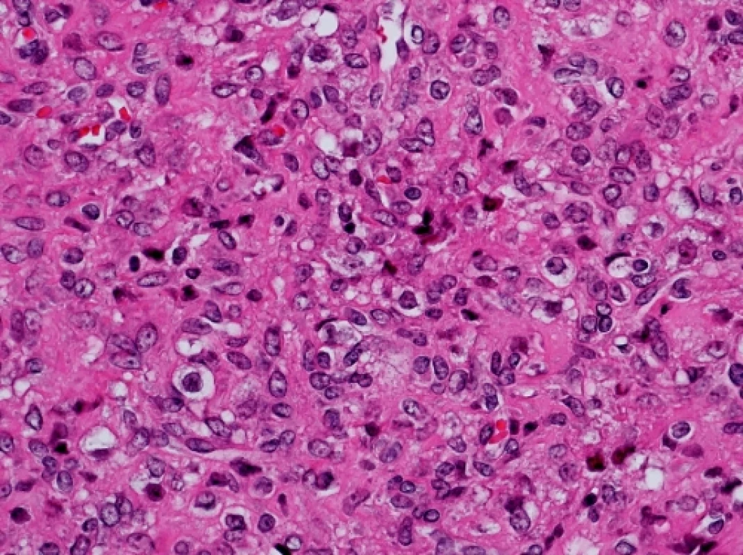 Nádorové buňky dvojího typu: vřetenité připomínající fibroblasty a polygonální až kulaté se světejší bohatou cytoplazmou (hematoxylin eozin, zvětšeno 400x)