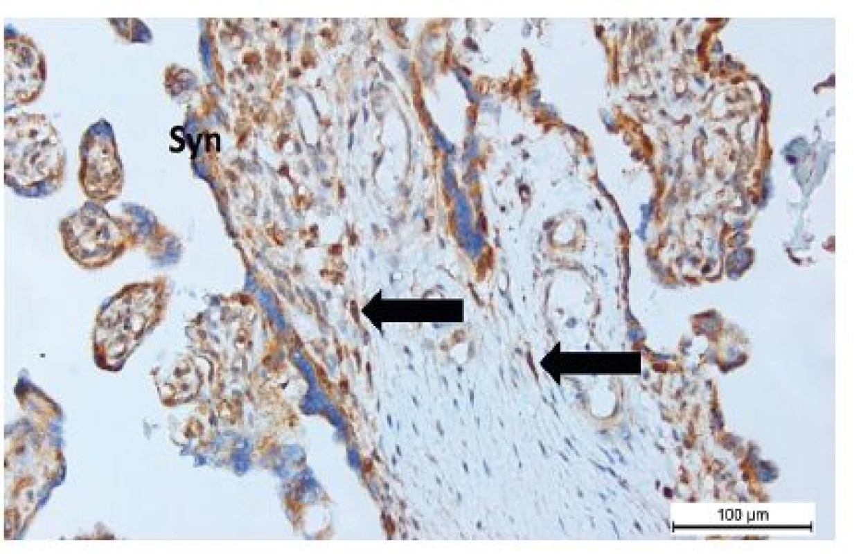Telocyty (šípky) vo väzive chóriových klkov placenty. Na povrchu klkov je vrstva syncytiotrofoblastu (Syn) (anti-CD117, vizualizované diaminobenzidínom do hneda, orig. zväčšenie 200x)
