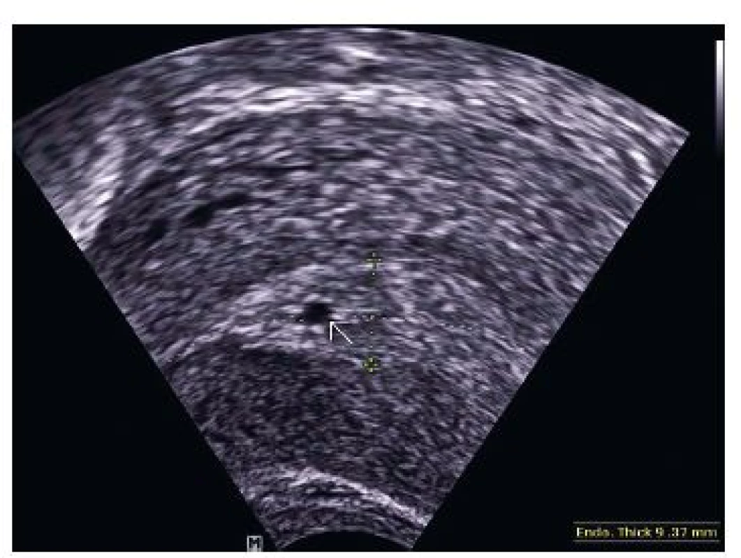 EE – 9, 37 mm, centrálně uložená anechogenní dutinka o průměru 0,22 mm ve dvouvrstevném endometriu bez charakteristického hyperechogenního lemu – pseudogestační váček
