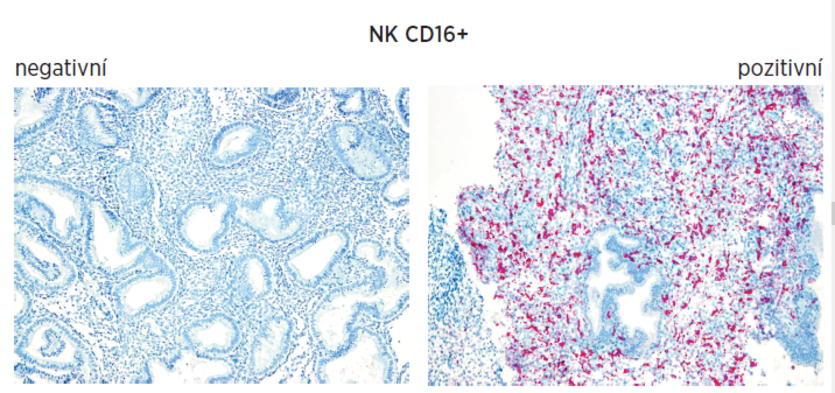 Immunohistochemie endometria při sledování NK bb CD16+