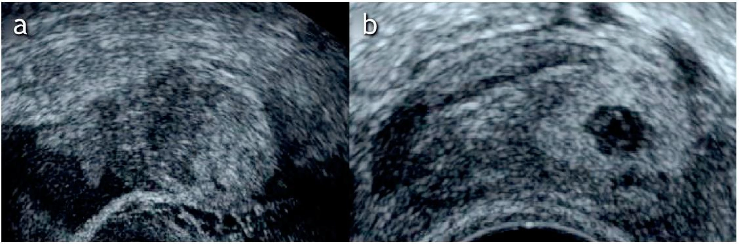 Ultrazvukový nález tubárního těhotenství
a) Ultrazvukové zobrazení extrauterinního nehomogenního útvaru v blízkosti ovaria, se kterým nejeví souhyby při tlaku sondou („blob sign“), grav. hebd. 6+3 podle PM (poslední menstruace)
b) Ultrazvukové zobrazení extrauterinně uloženého gestačního váčku s hyperechogenním prstencem („bagel sign“), grav. hebd. 5+3 podle PM