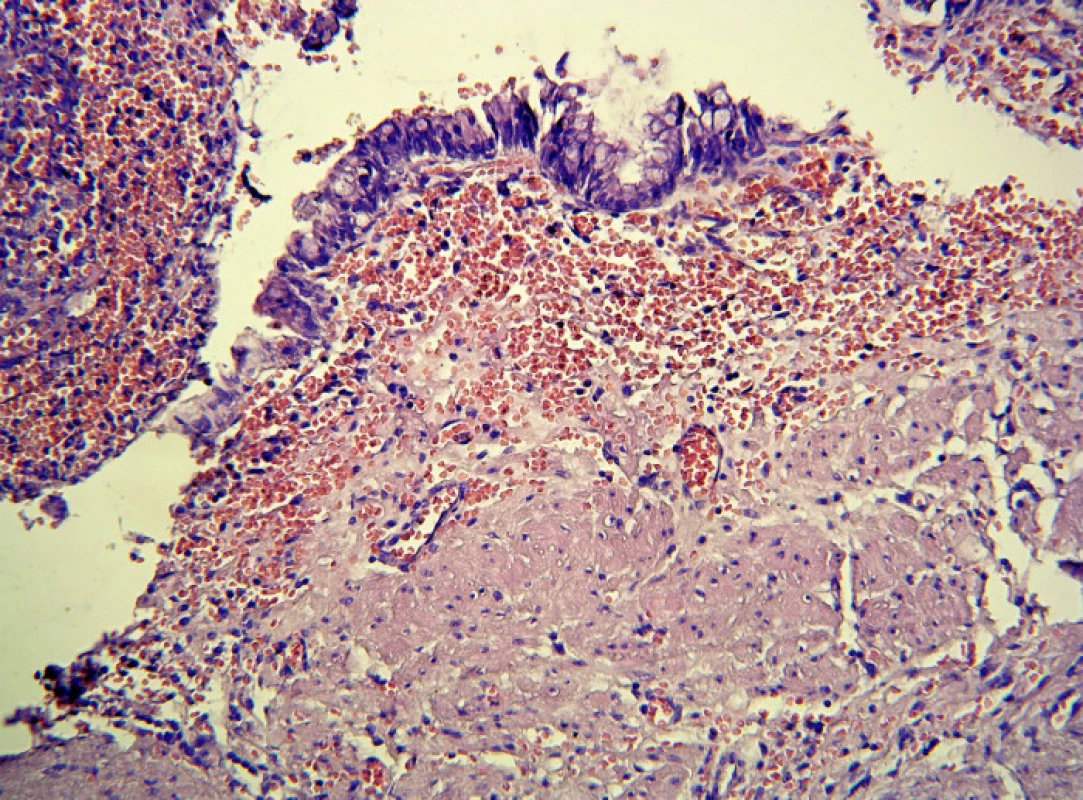 Histologický nález stěny cystické duplikatury rekta. Zachycen je jednovrstevný cylindrický epitel a pod ním lamina muscularis mucosae