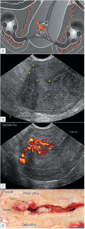 Endometriální karcinom s nízkým rizikem postižení lymfatických uzlin (FIGO stadium IA)