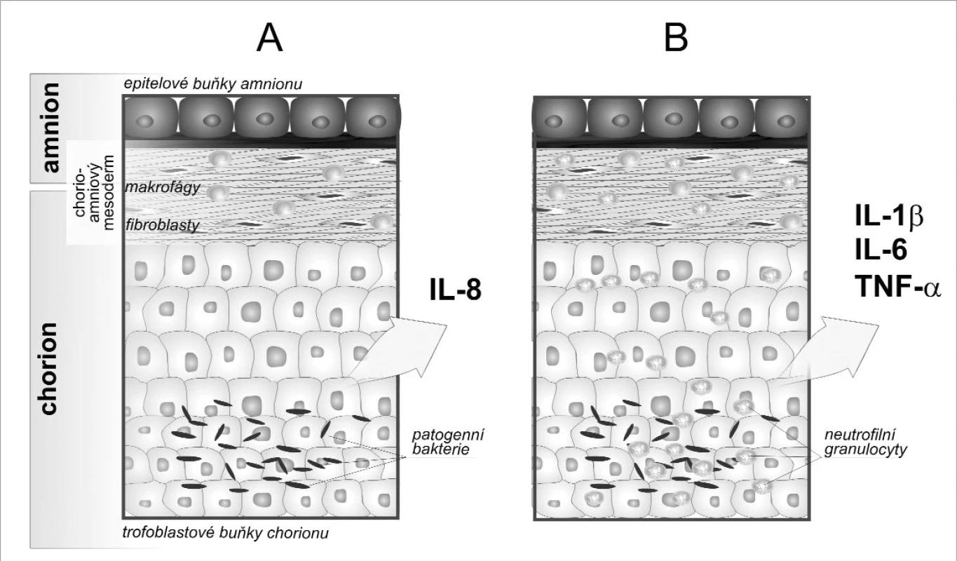 Schematické znázornění chorioamnionitidy
A. Mikrobiální invaze aktivuje buňky plodových obalů k produkci chemotaktického cytokinu interleukinu 8.
B. Jako odpověď na zvýšené koncentrace IL-8 infiltrují neutrofily matky do plodových obalů a spolu s placentálními makrofágy tvoří prozánětové cytokiny IL-1β, IL-6 a tumor nekrotizující faktor (TNF) α. Zvýšení hladin cytokinů je možné sledovat v plodové vodě.