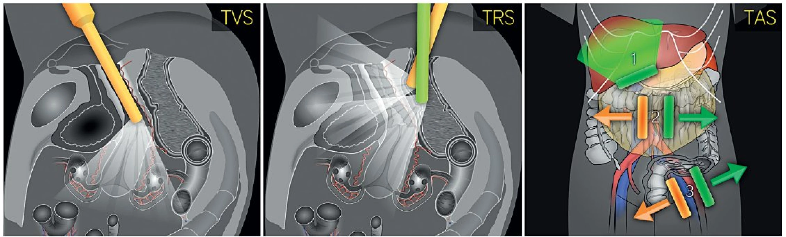 Postup ultrazvukového vyšetření při předoperačním screeningu endometriálního karcinomu